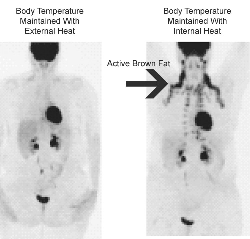 Active Brown Fat Image Active Brown Fat Image